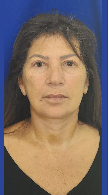 Lifting Facial - Después