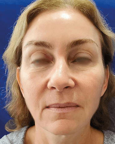 Lifting Facial - Antes